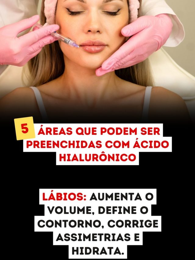 PREENCHIMENTOLABIAL1