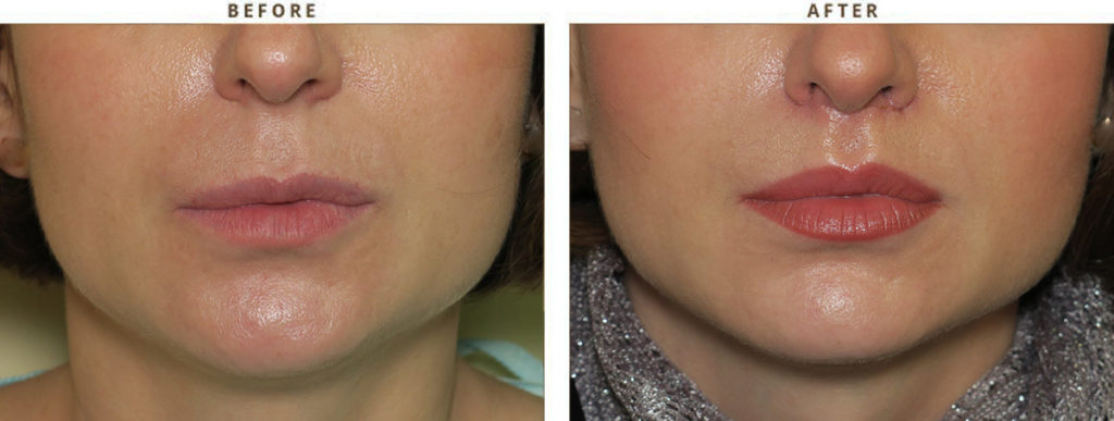 Plasma Lift - Rejuvenescimento Facial