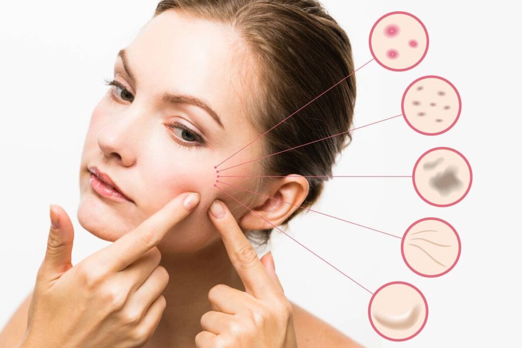 Os tipos de Peeling para rejuvenescimento facial.